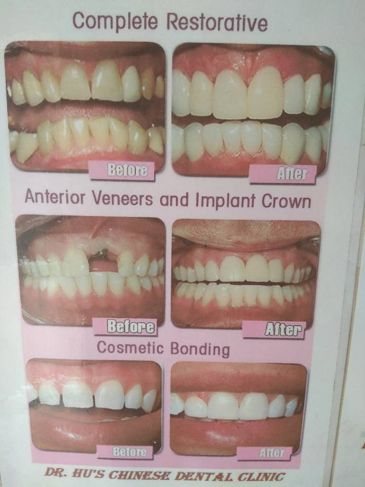 IMPLANTS, ROOT CANAL TREATMENT, SMILE CORRECTIONS